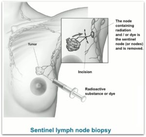 sentinel node biopsy